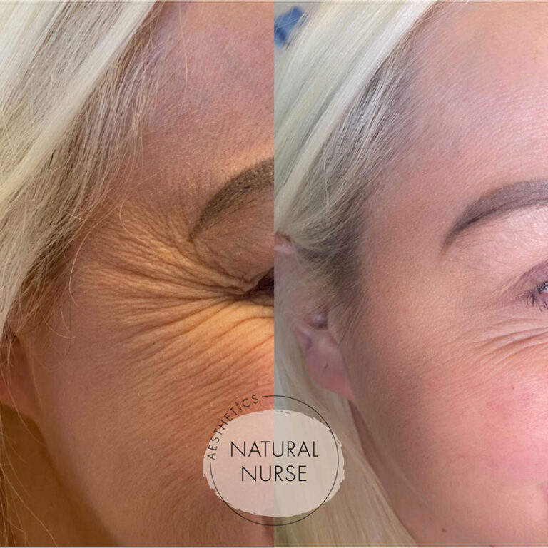 anti wrinkle treatment before and after