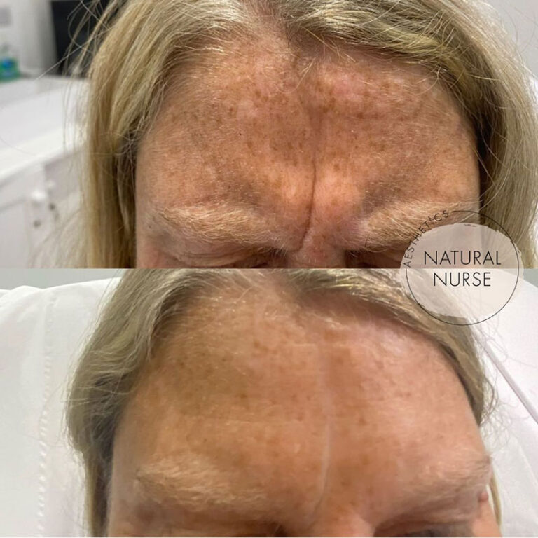 anti wrinkle treatment before and after