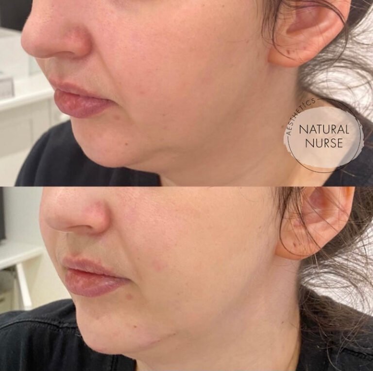 dermal fillers before and after