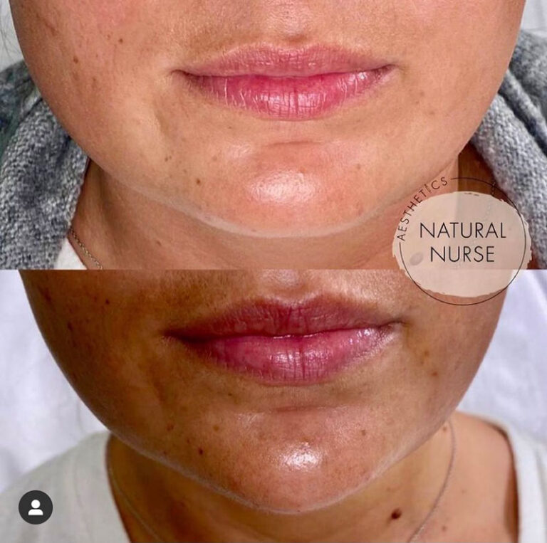 dermal fillers before and after