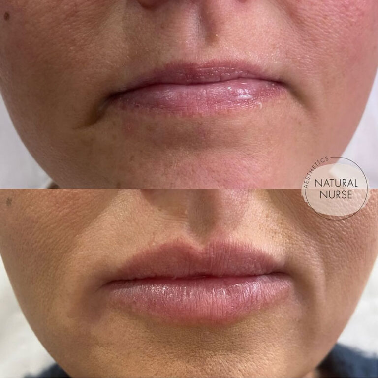 dermal fillers before and after