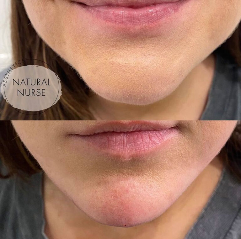 dermal fillers before and after