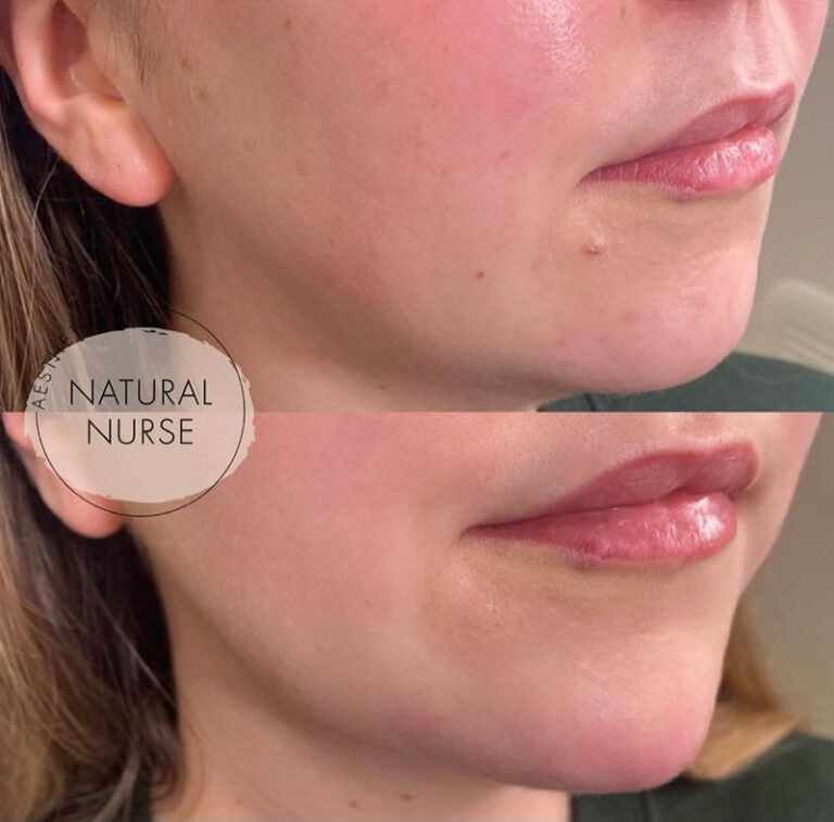 dermal fillers before and after