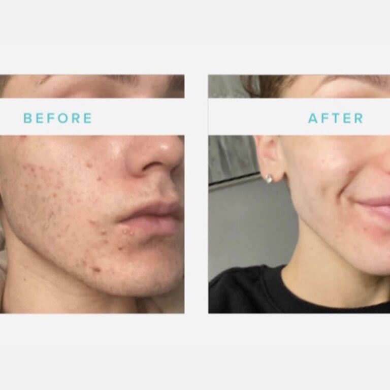 dermaplaning and skin peel before and after