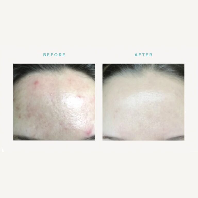 dermaplaning and skin peel before and after 2