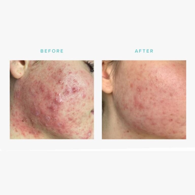 dermaplaning and skin peel before and after 3