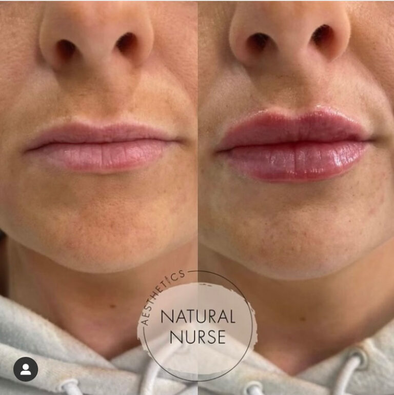 lip augmentation before and after
