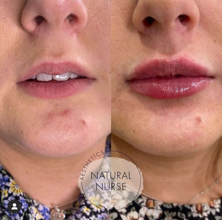 lip augmentation before and after