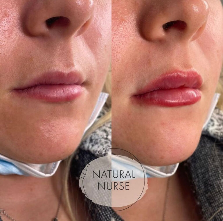 dermal fillers before and after