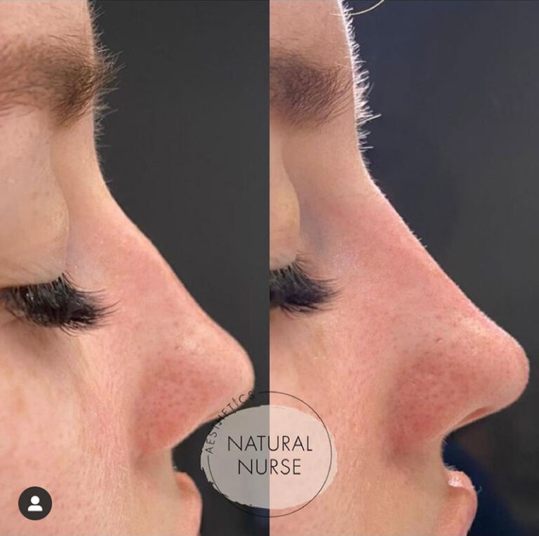 non surgical rhinoplasty before and after