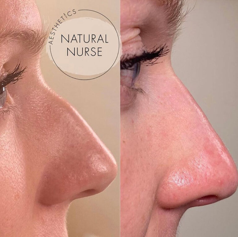 non surgical rhinoplasty before and after