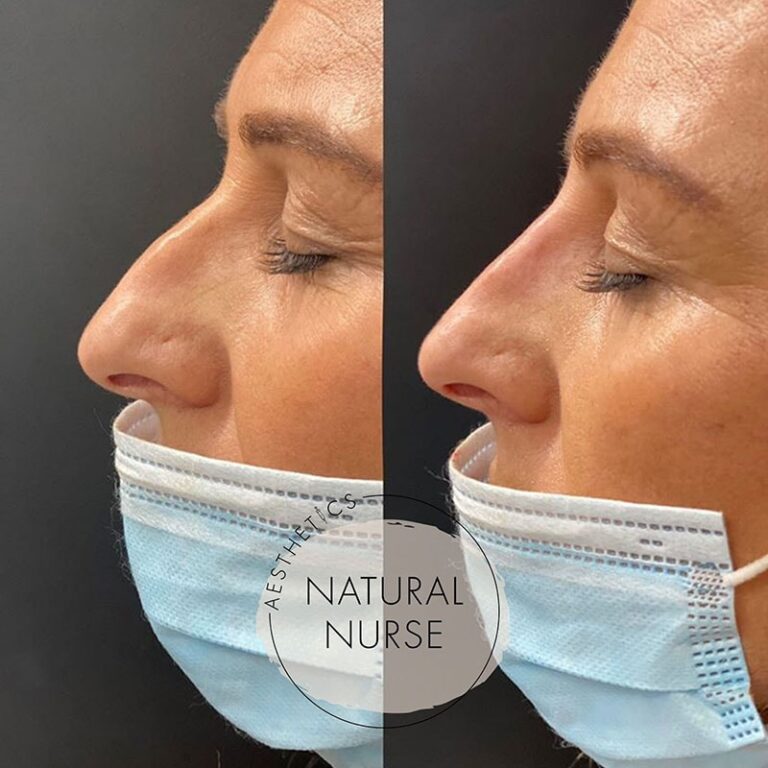 non surgical rhinoplasty before and after