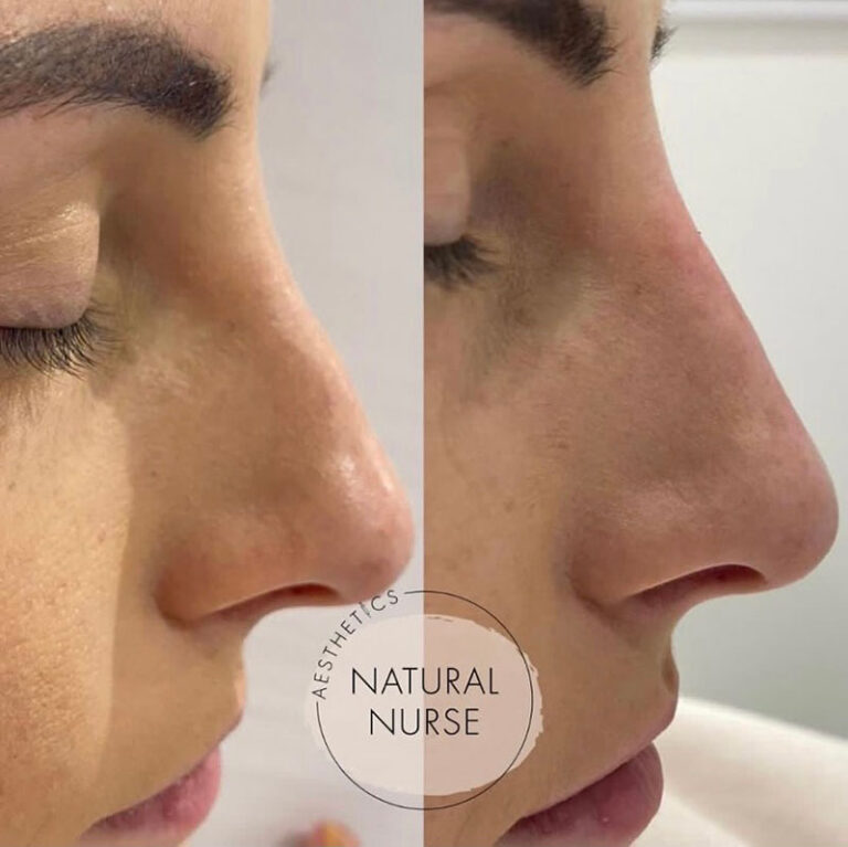 non surgical rhinoplasty before and after