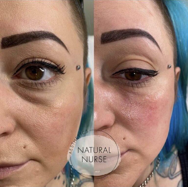 tear trough treatment-before and after