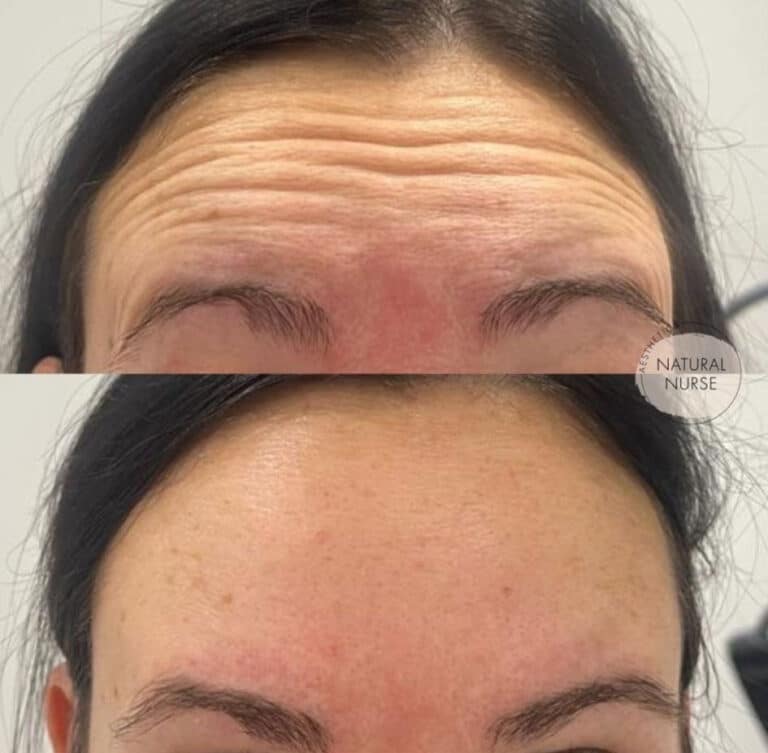 Dermal Fillers for forehead wrinkles at Natural Nurse Aesthetics Wigan
