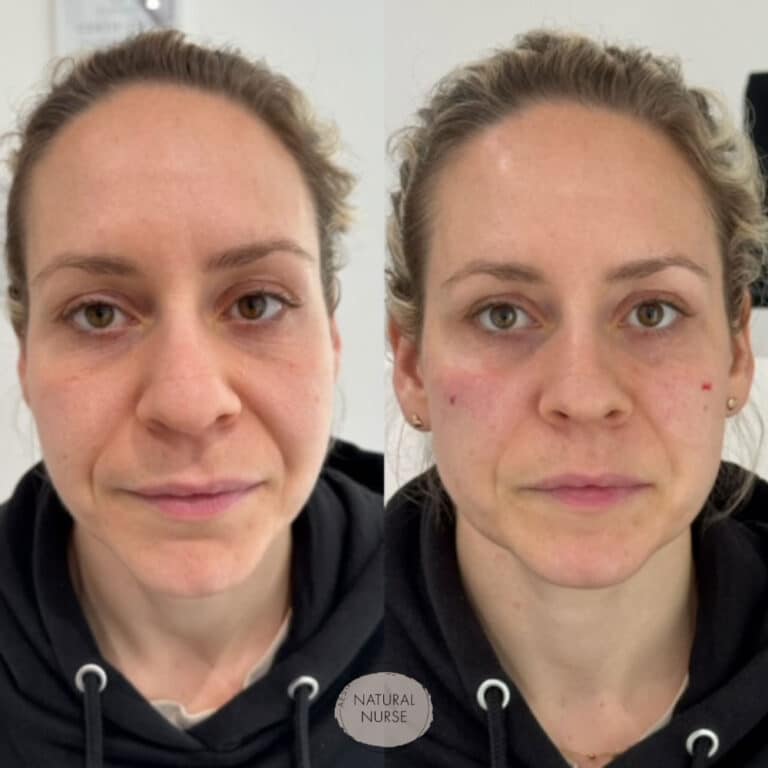 Cheek fillers treatment Wigan by Natural Nurse Aesthetics