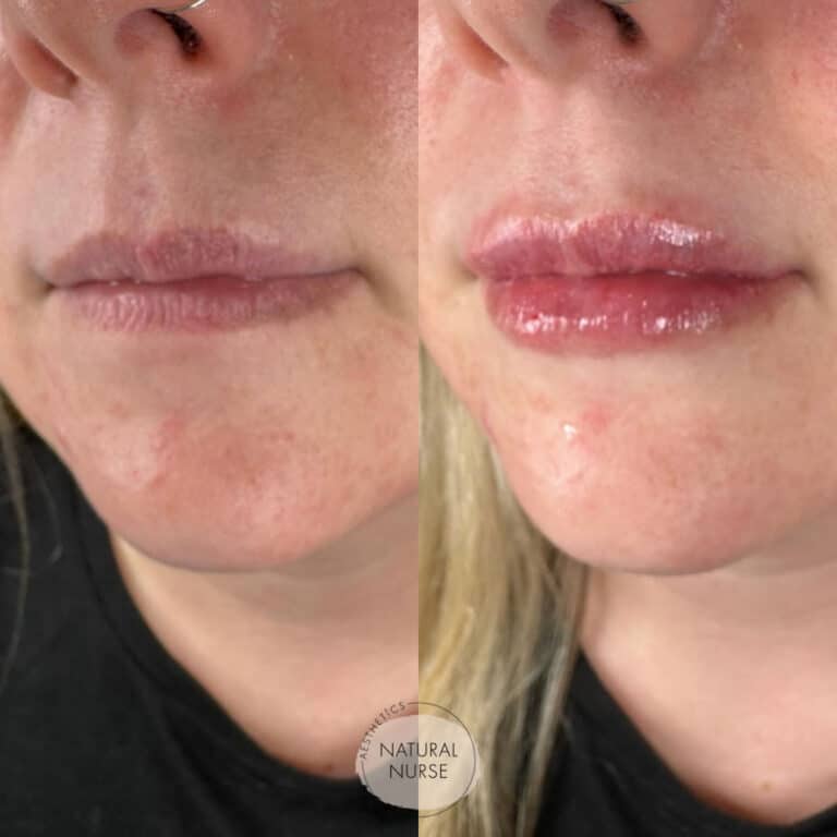 Lip fillers by Natural Nurse Aesthetics Wigan before and after