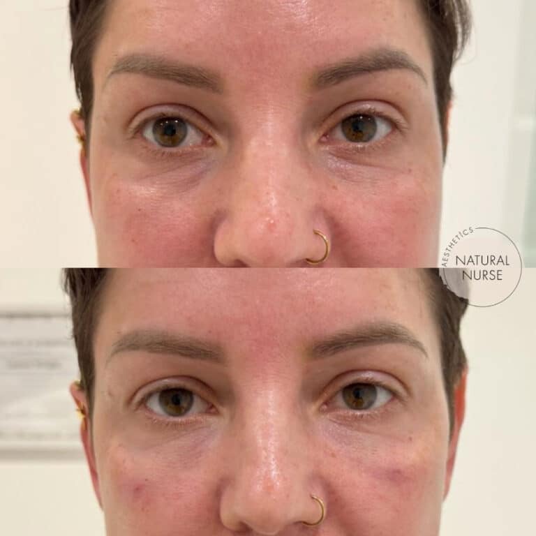 Under eye treatment at Natural Nurse Aesthetics Wigan