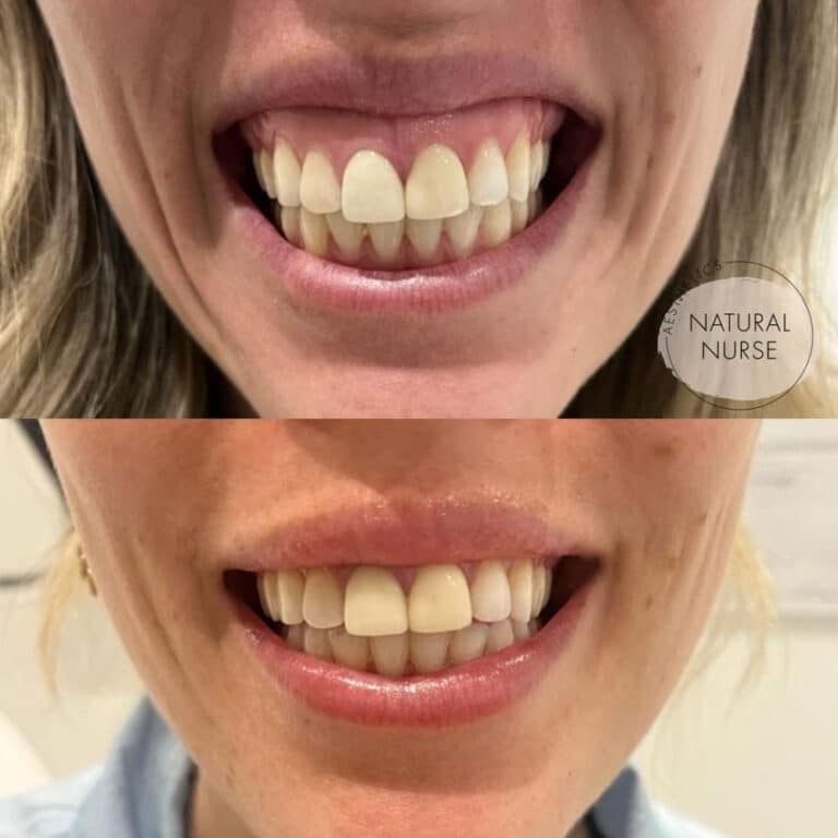 Lip Filler for gummy smile at Natural Nurse Aesthetics Wigan