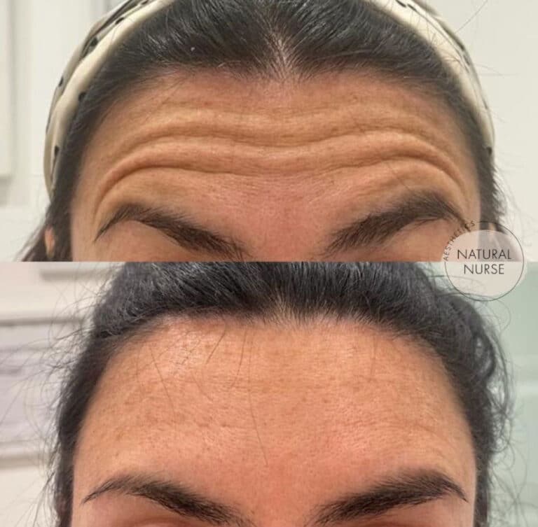 Dermal Fillers for forehead wrinkles at Natural Nurse Aesthetics Wigan