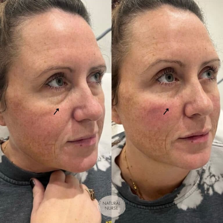 Under eye treatment Wigan by Natural Nurse Aesthetics