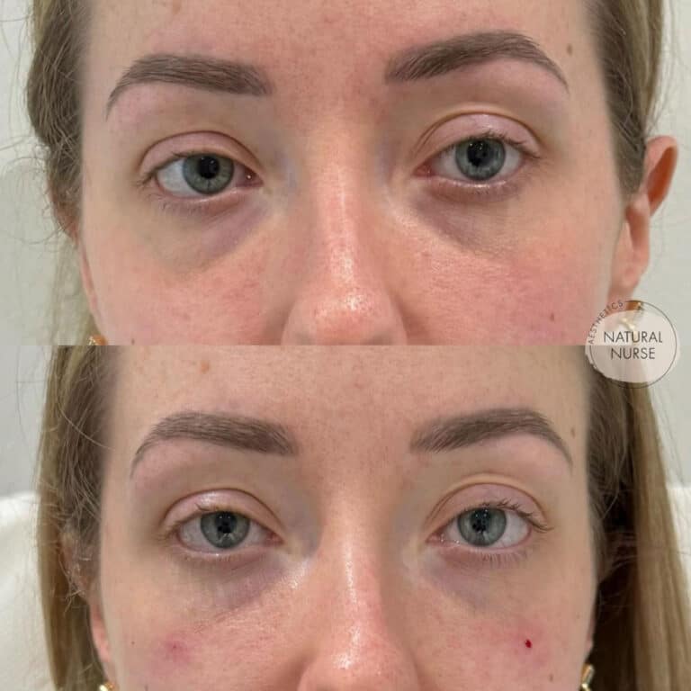 Tear trough treatment Wigan by Natural Nurse