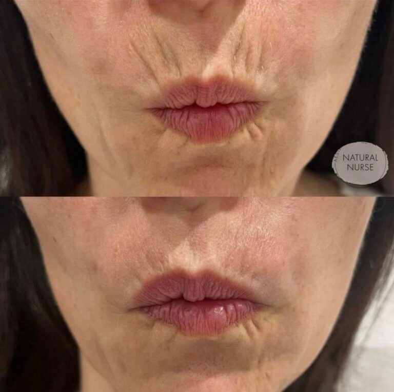 Antiwrinkle for mouth lines before and after at Natural Nurse in Wigan