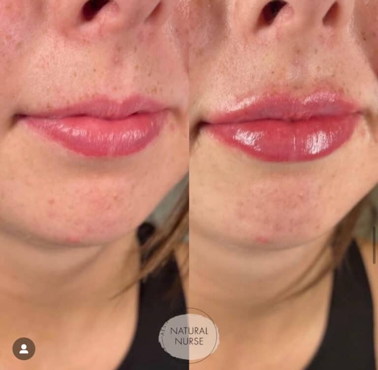 Lip fillers by Natural Nurse Aesthetics Wigan before and after
