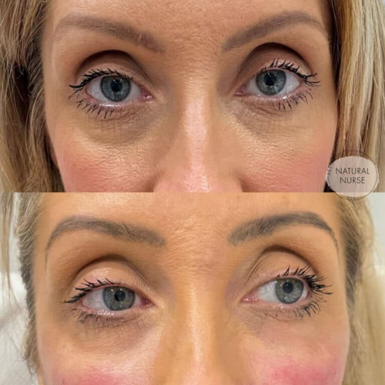 Face rejuvenation results before and after at Natural Nurse in Wigan