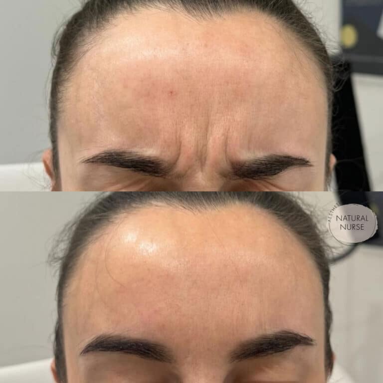 Dermal Fillers for forehead wrinkles at Natural Nurse Aesthetics Wigan