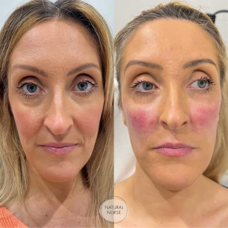 Cheek fillers treatment Wigan by Natural Nurse Aesthetics
