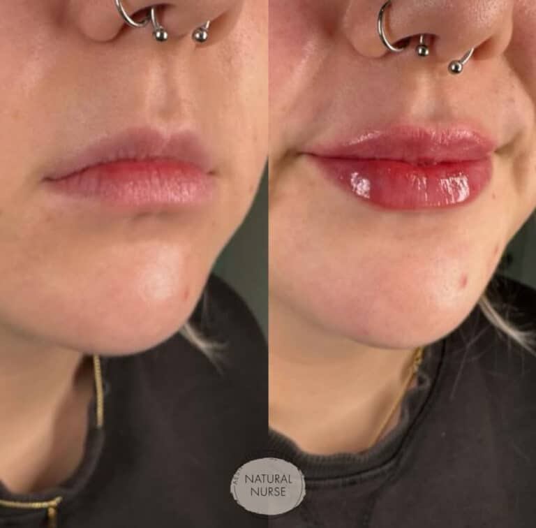 Lip fillers by Natural Nurse Aesthetics Wigan before and after