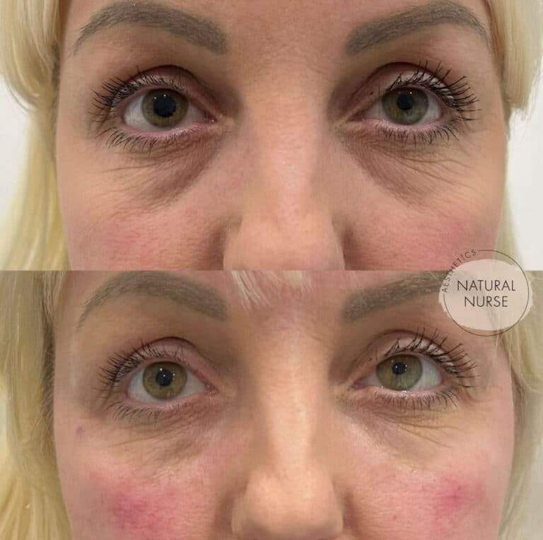 Face rejuvenation results before and after at Natural Nurse in Wigan
