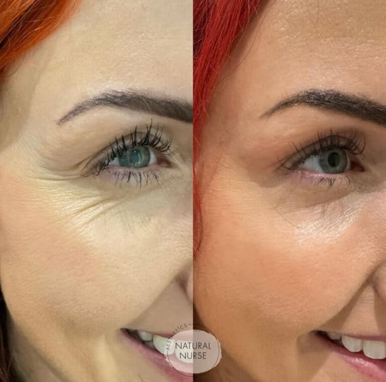 Dermal Fillers for crows feet at Natural Nurse Aesthetics Wigan