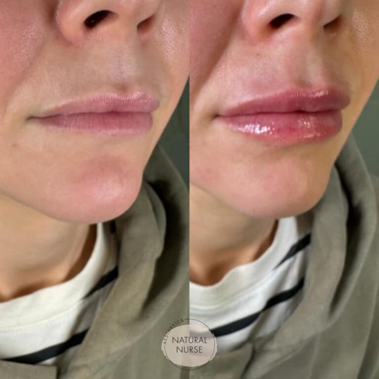 Lip fillers by Natural Nurse Aesthetics Wigan before and after