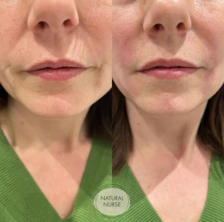 Lip Fillers Wigan before and after
