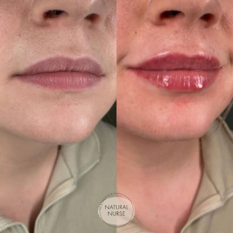 Lip fillers by Natural Nurse Aesthetics Wigan before and after