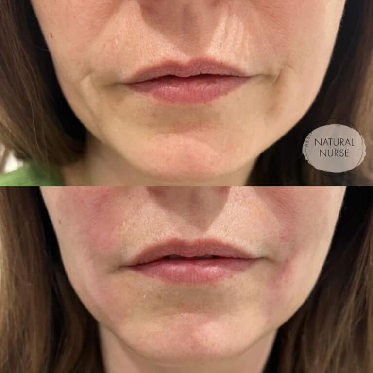 Lip Filler before and after by Natural Nurse Aesthetics in Wigan