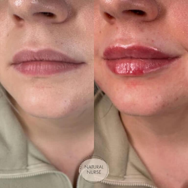 Lip fillers by Natural Nurse Aesthetics Wigan before and after