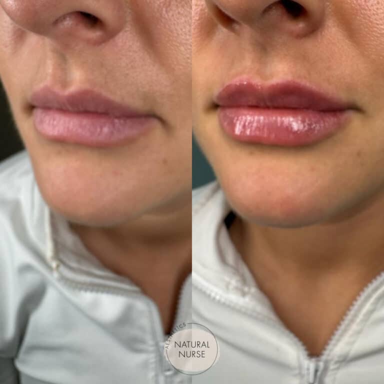 Lip fillers Wigan before and after by Natural Nurse Aesthetics