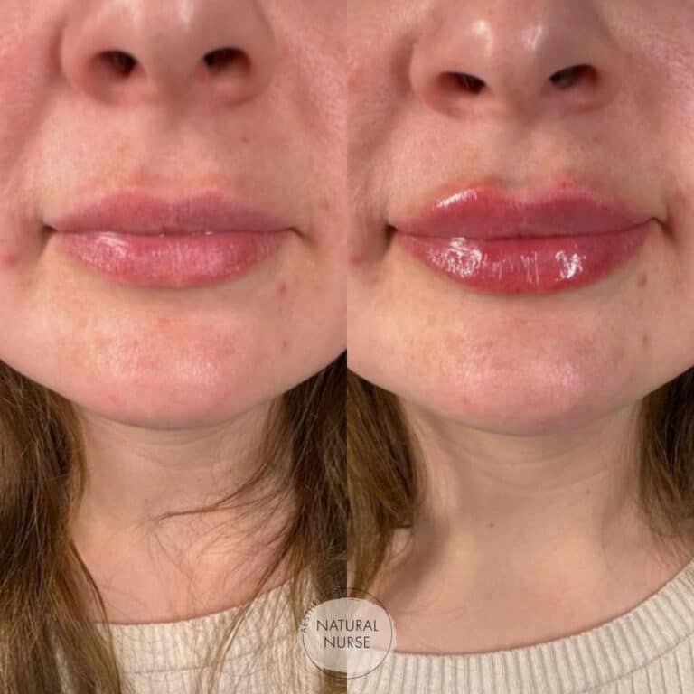 Lip fillers Wigan before and after by Natural Nurse Aesthetics