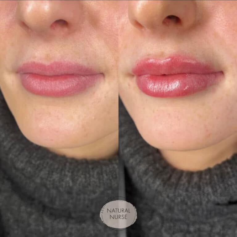 Lip fillers Wigan before and after by Natural Nurse Aesthetics