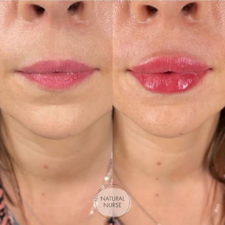 Lip fillers Wigan before and after by Natural Nurse Aesthetics