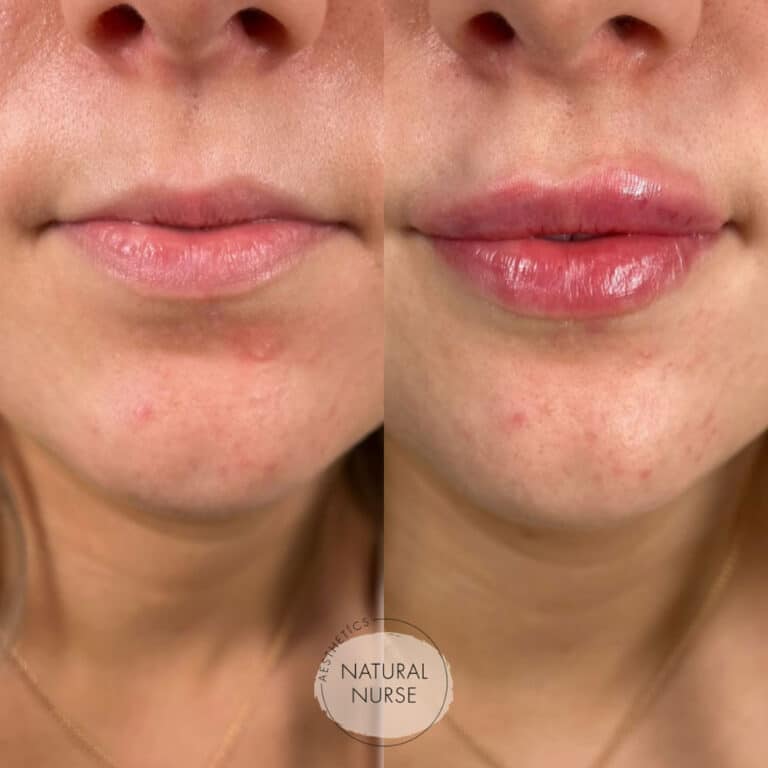 Lip fillers Wigan before and after by Natural Nurse Aesthetics